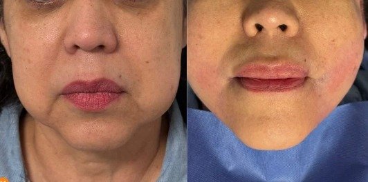 Antes y después Bichectomia