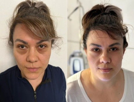 Antes y después Blefaroplastia