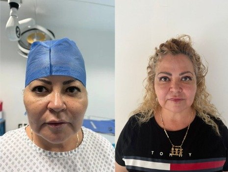 Antes y después Blefaroplastia caso 2
