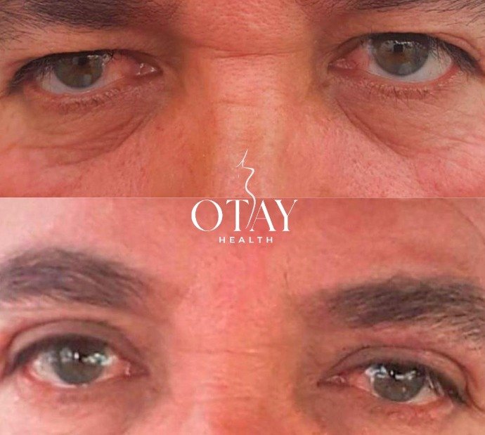 Antes y después Blefaroplastia caso 3