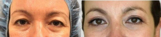 Antes y después Blefaroplastia caso 4