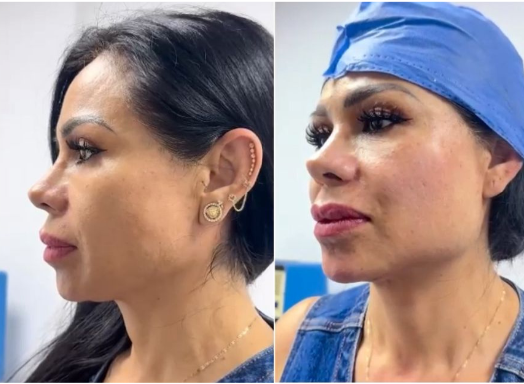 Antes y después Endolift Caso 3