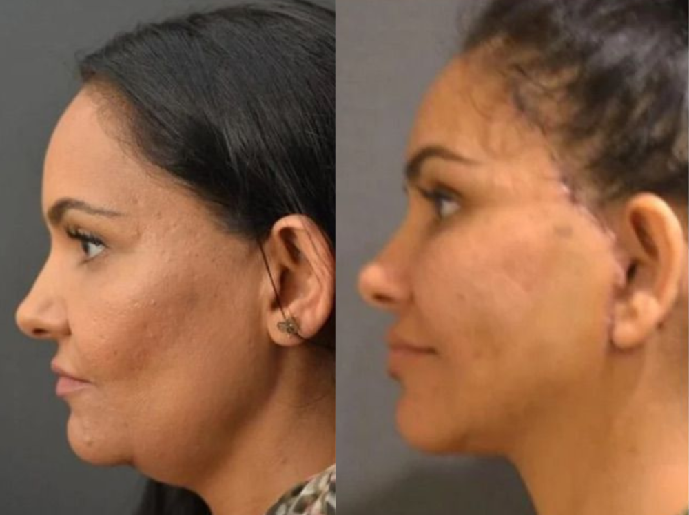 Antes y después Lipopapada Caso 1