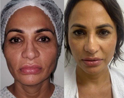 Antes y después Mini Facelift Caso 1