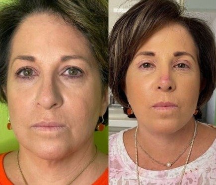 Antes y después Mini Facelift Caso 2