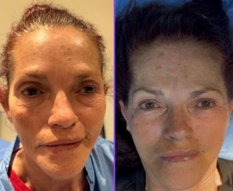 Antes y después Mini Facelift Caso 3