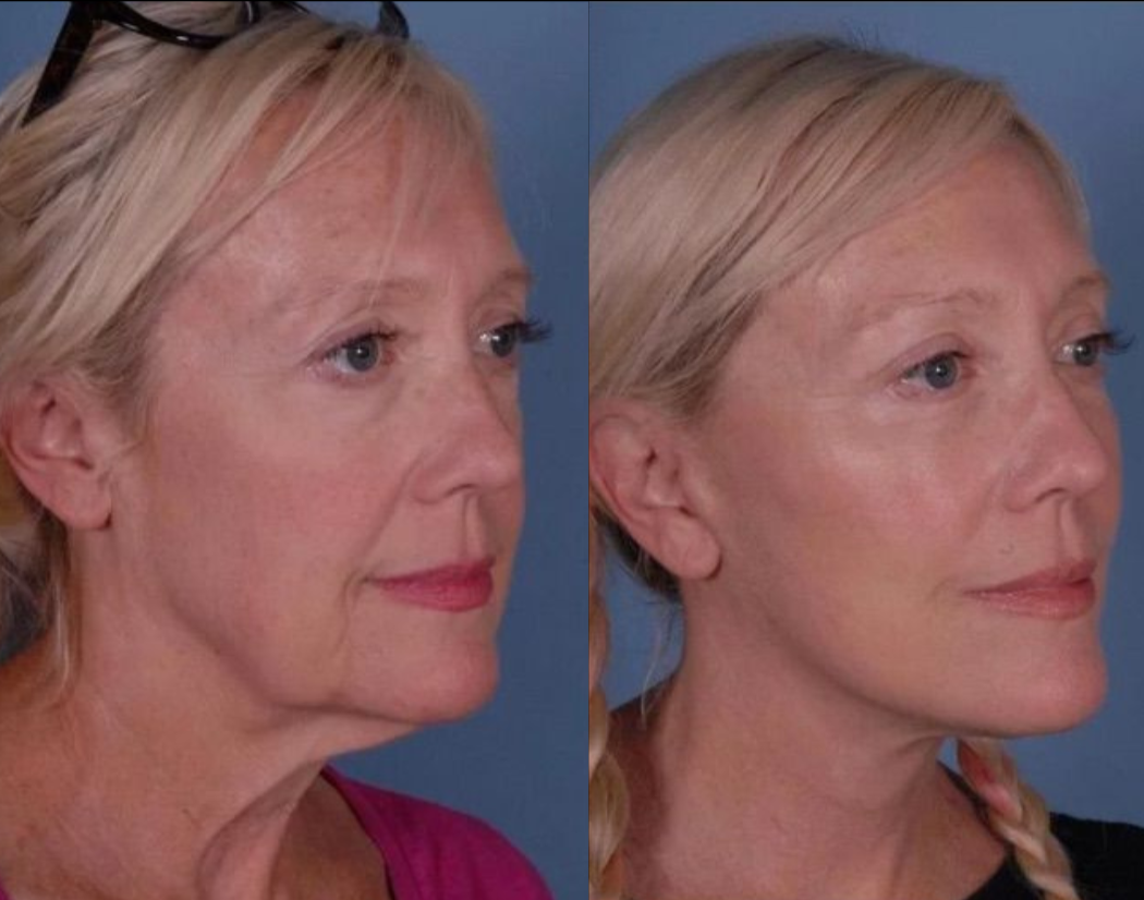 Antes y después Mini Facelift Caso 5