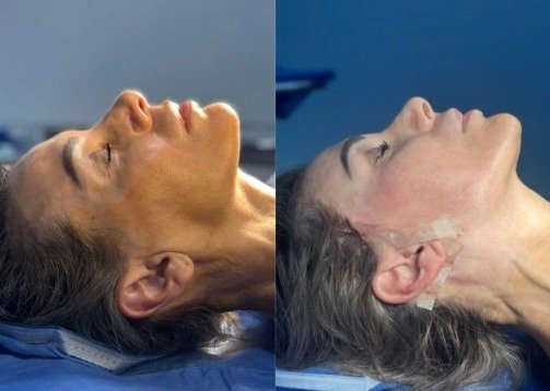 Antes y después Mini Facelift Caso 6