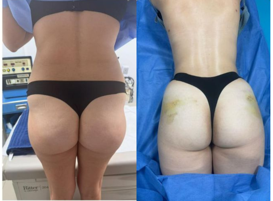 Antes y después Mini lipo bbf caso 1