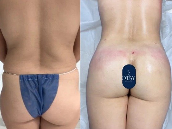 Antes y después Mini lipo bbf caso 2