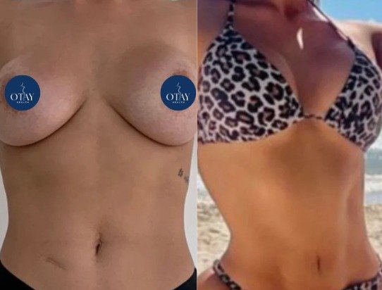 Antes y después Mini lipo caso 2