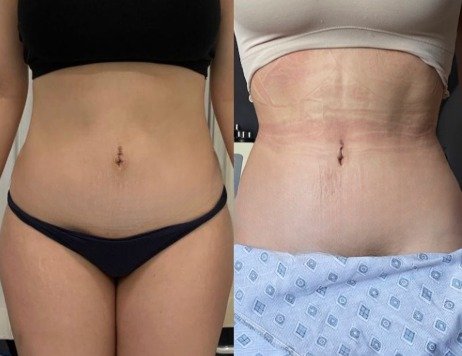 Antes y después Mini lipo caso 3