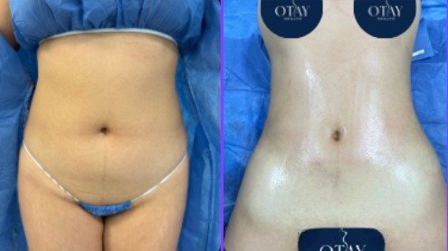 Antes y después Mini lipo caso 4
