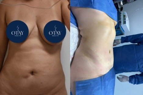 Antes y después Mini lipo caso 5
