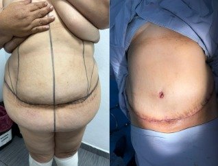 Antes y después de abdominoplastia caso 1