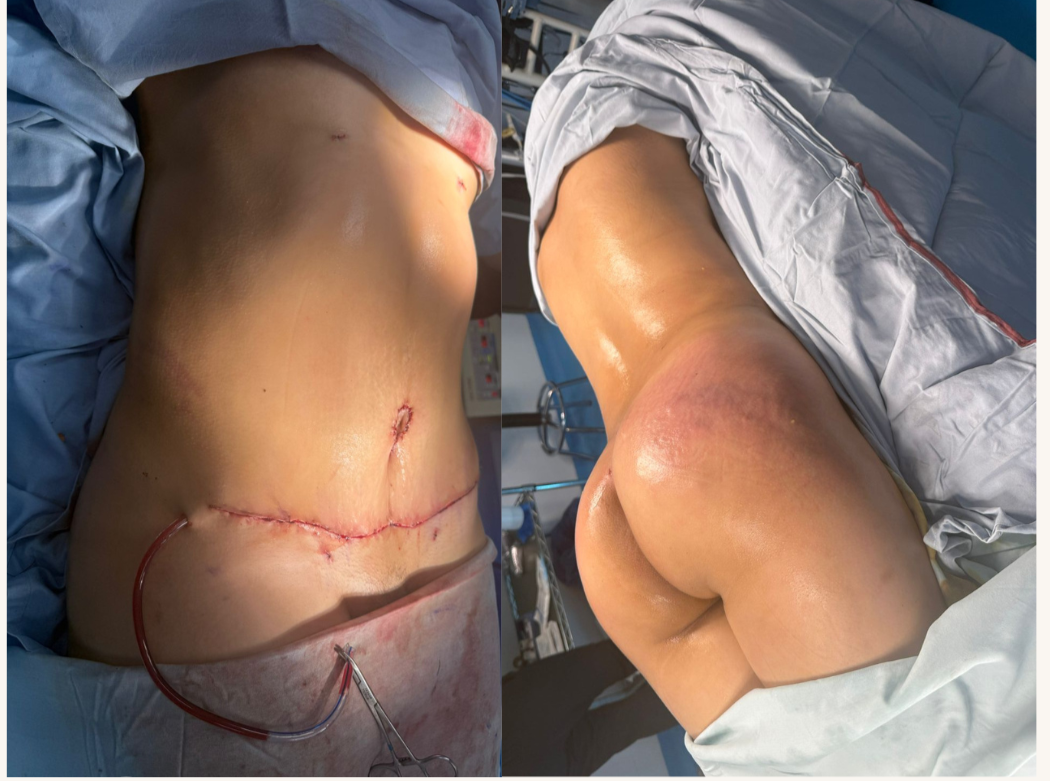 Antes y después de abdominoplastia caso 2