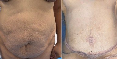 Antes y después de abdominoplastia caso 4