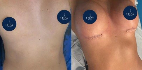 Antes y después implantes de seno caso 1