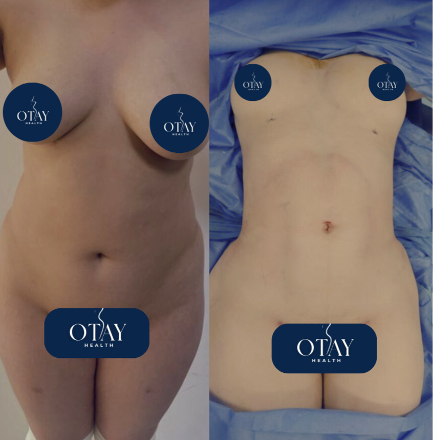 Antes y después de liposuccion caso 1